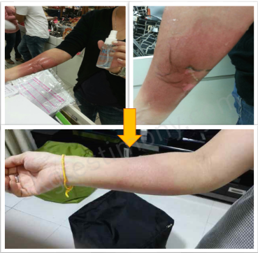 手臂的伤疤已经痊愈了