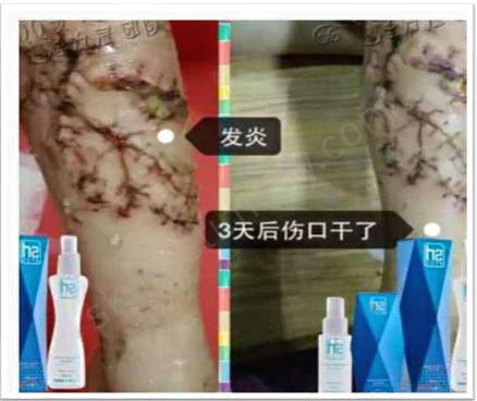 伤口开始愈合了