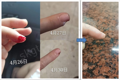 手指割伤，很快好,也没那么痛