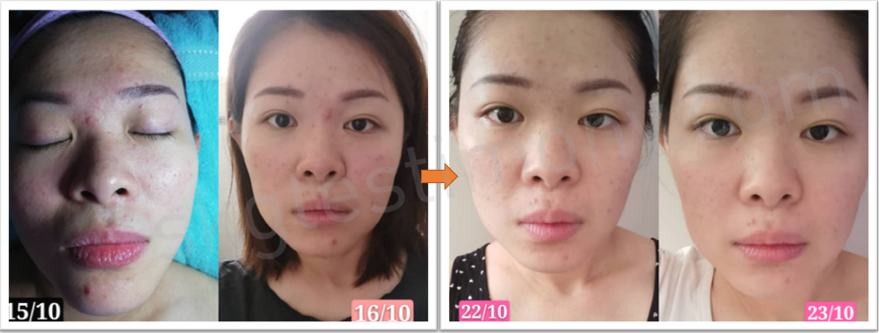 脸上痘痘的问题改善了