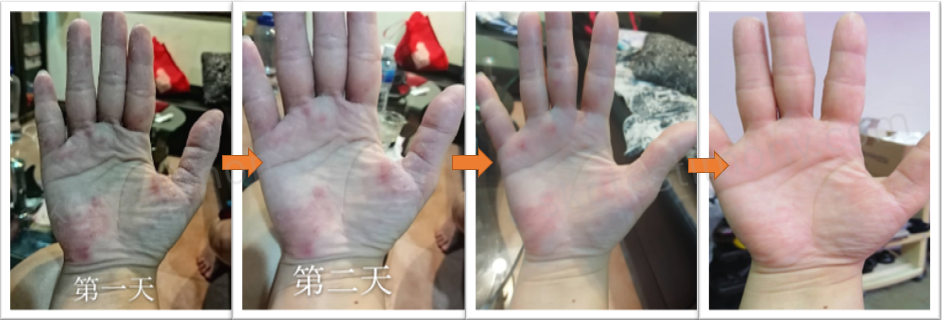 第二天伤口愈合了