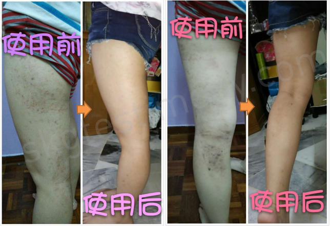 鼻子敏感&皮肤敏感改善了，疤印浅化了
