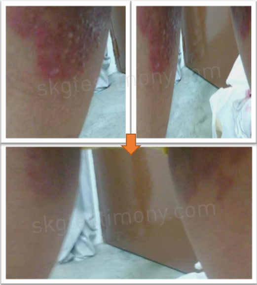 我的大腿没那么红肿了
