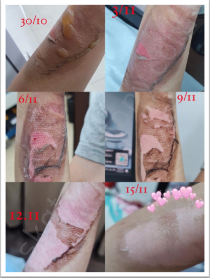 2个星期修复烫伤的皮肤