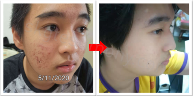 痘痘远离我！